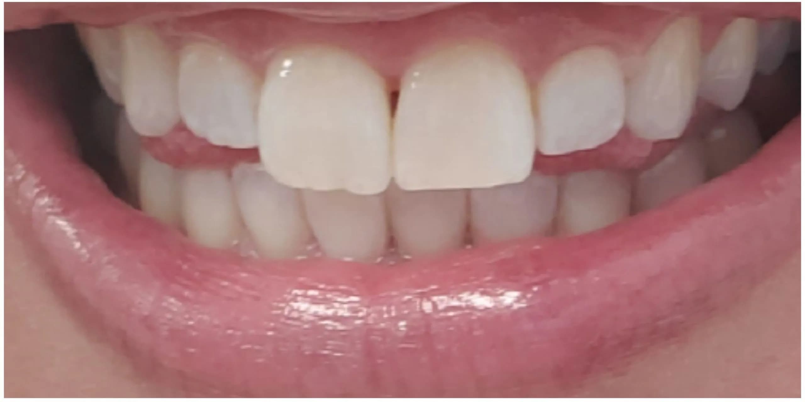 After: GLO Professional Whitening