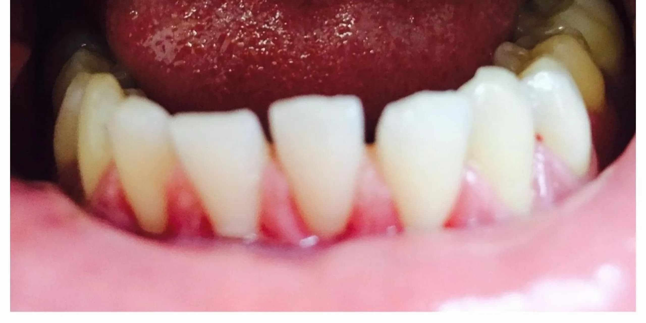 After: Professional Dental Cleaning
