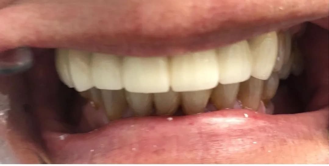 After: Veneer Smile Enhancement