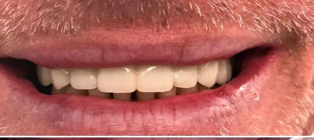 After: Full Smile Makeover