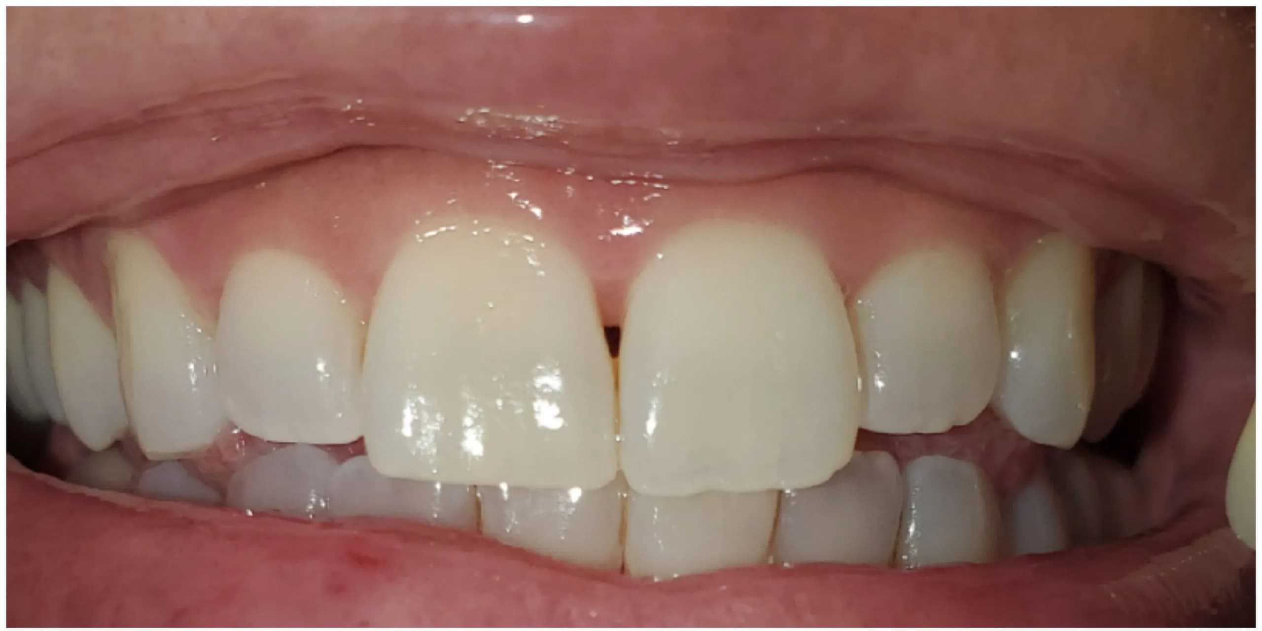 Before: GLO Professional Whitening