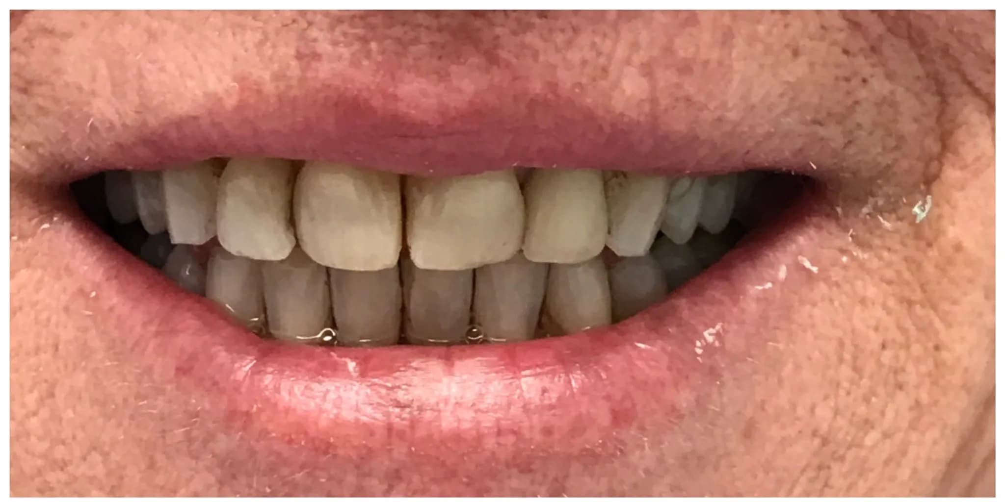Before: Invisalign Alignment