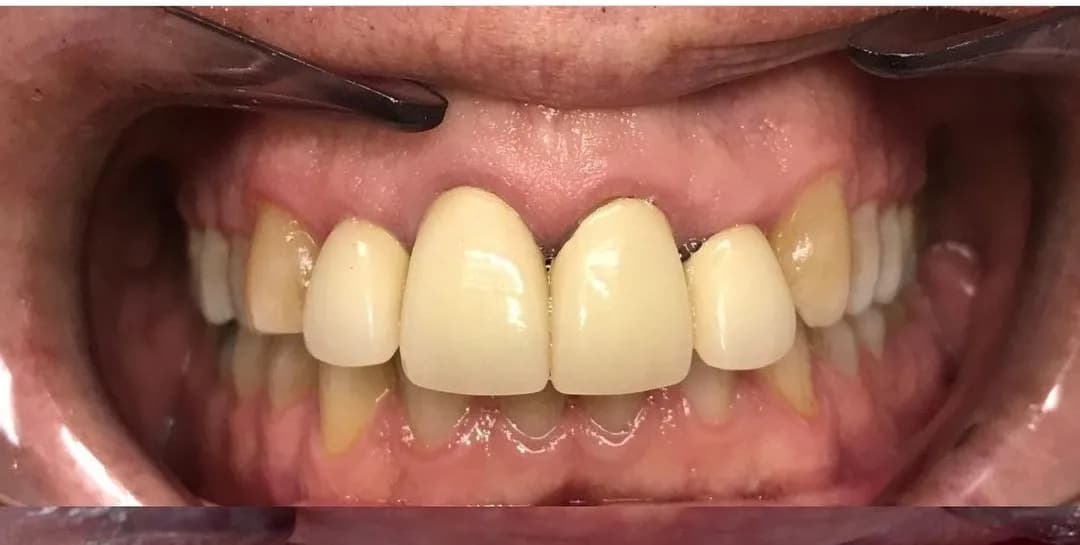 Before: Porcelain Crown