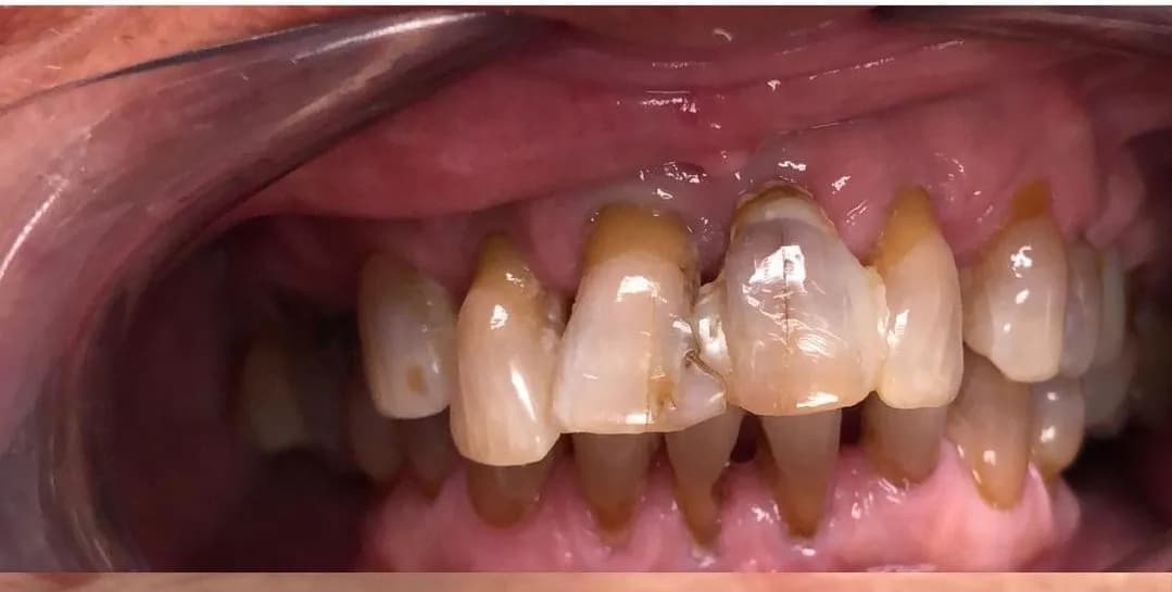 Before: Veneer Smile Enhancement