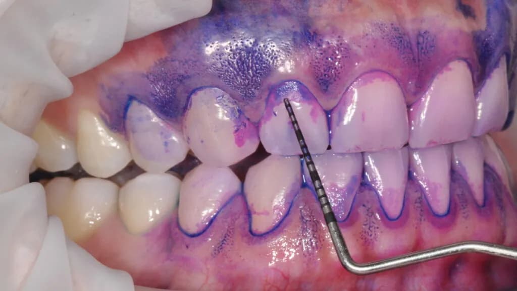 Biofilm Disclosing