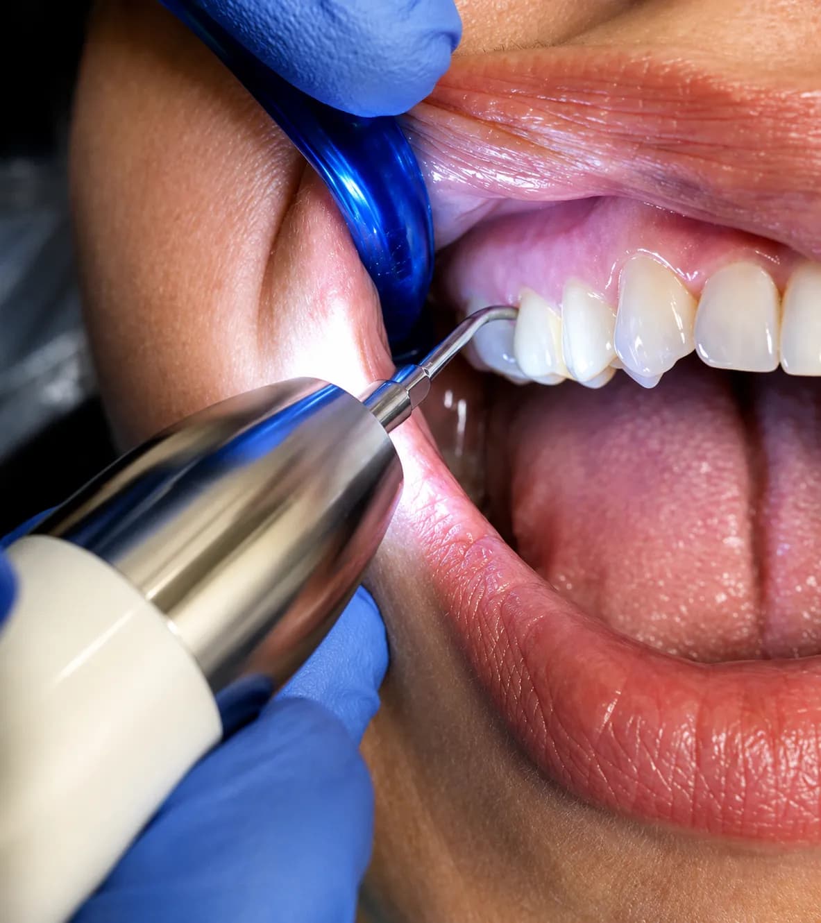Dental hygienist performing deep scaling and cleaning